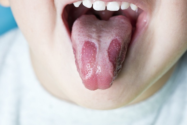 misteri-lidah-4-jenis-penyakit-langka-yang-sering