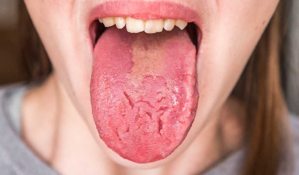 misteri-lidah-4-jenis-penyakit-langka-yang-sering