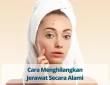 Cara Menghilangkan Jerawat